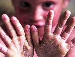 واکسن پیشکش؛ به کودکان «پروانه‌ای» رحم می‌کردید!